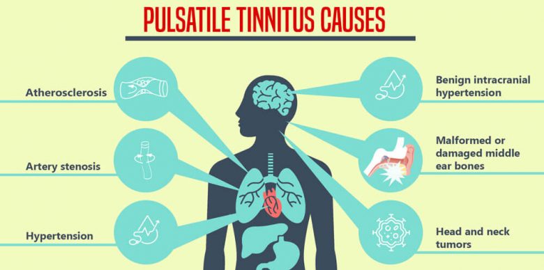 Can Pulsatile Tinnitus Happen Suddenly